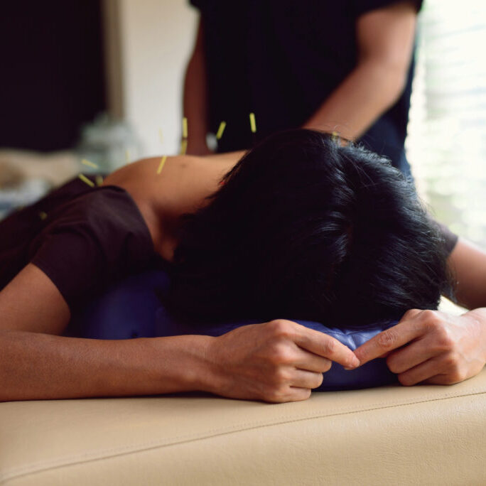 A woman having acupuncture.